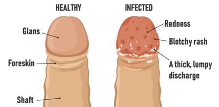 balanitis updated