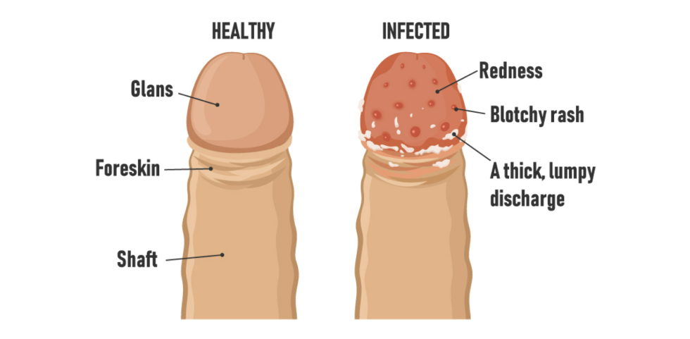 Circumcision diabetes img