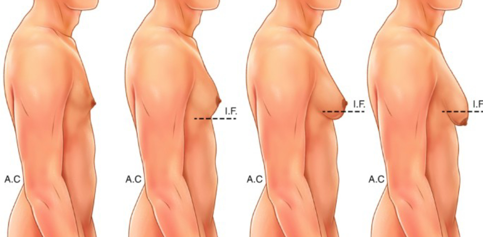 Gynecomastia Grade