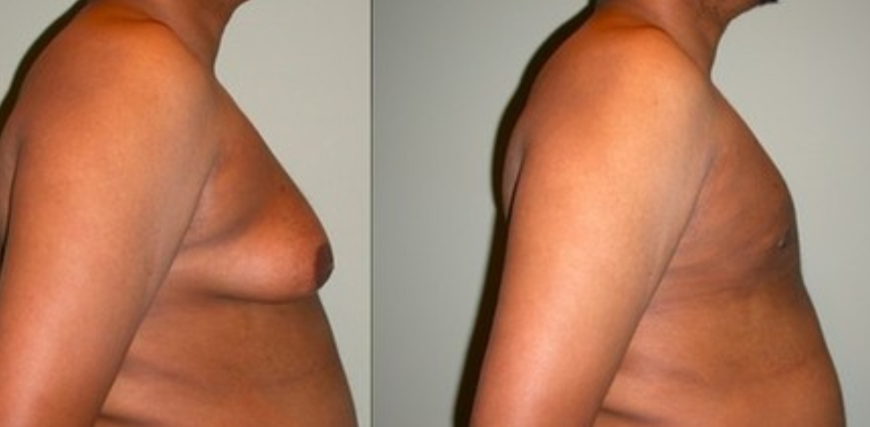 Gynecomastia right image