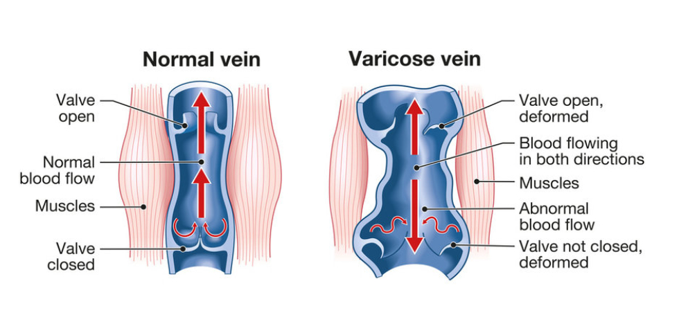 Varicose Veins img 1