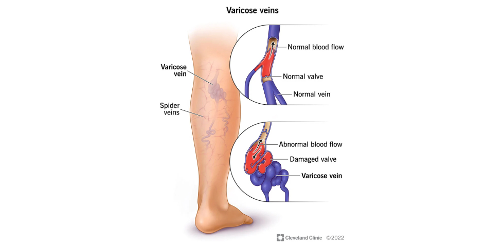 Varicose Veins img 2