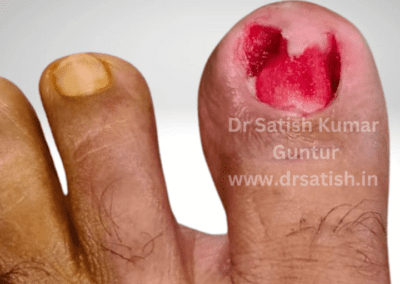 A Case of Ingrown Toenail