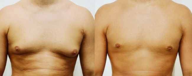 Gynecomastia right image