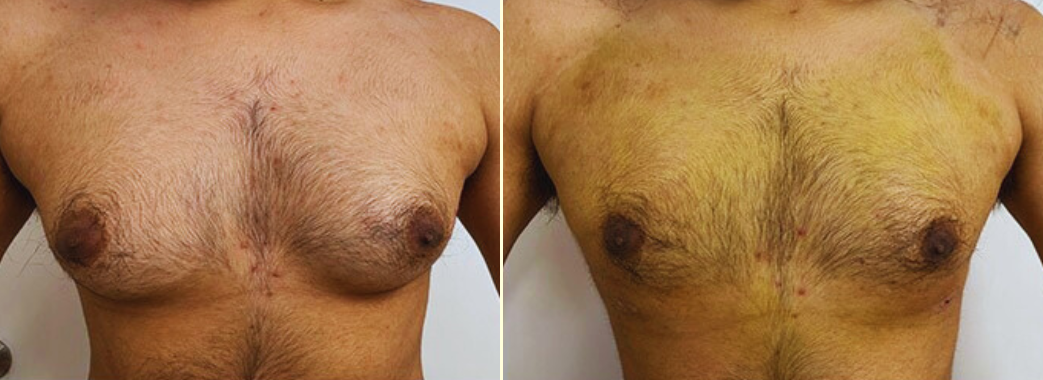 Gynecomastia right image