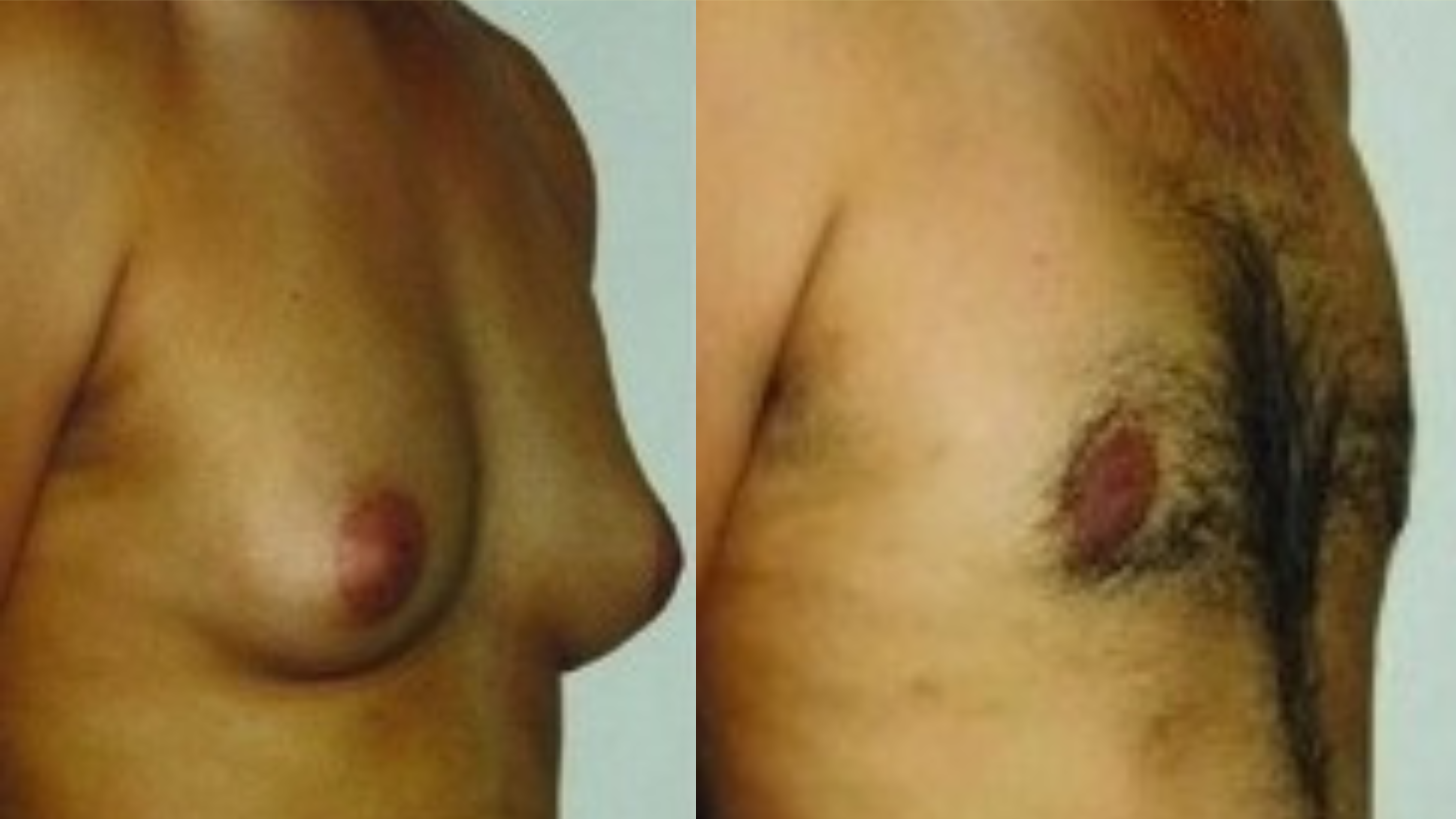 Gynecomastia right image