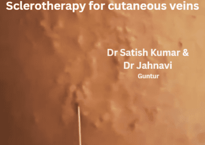 Sclerotherapy: For Cutaneous Veins