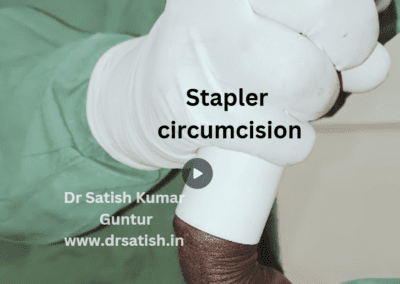 Story of Modern Circumcision