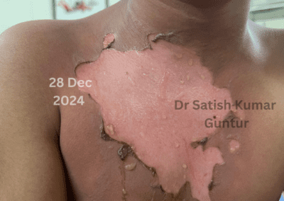 Hot water Burns: A 9-Year old girl