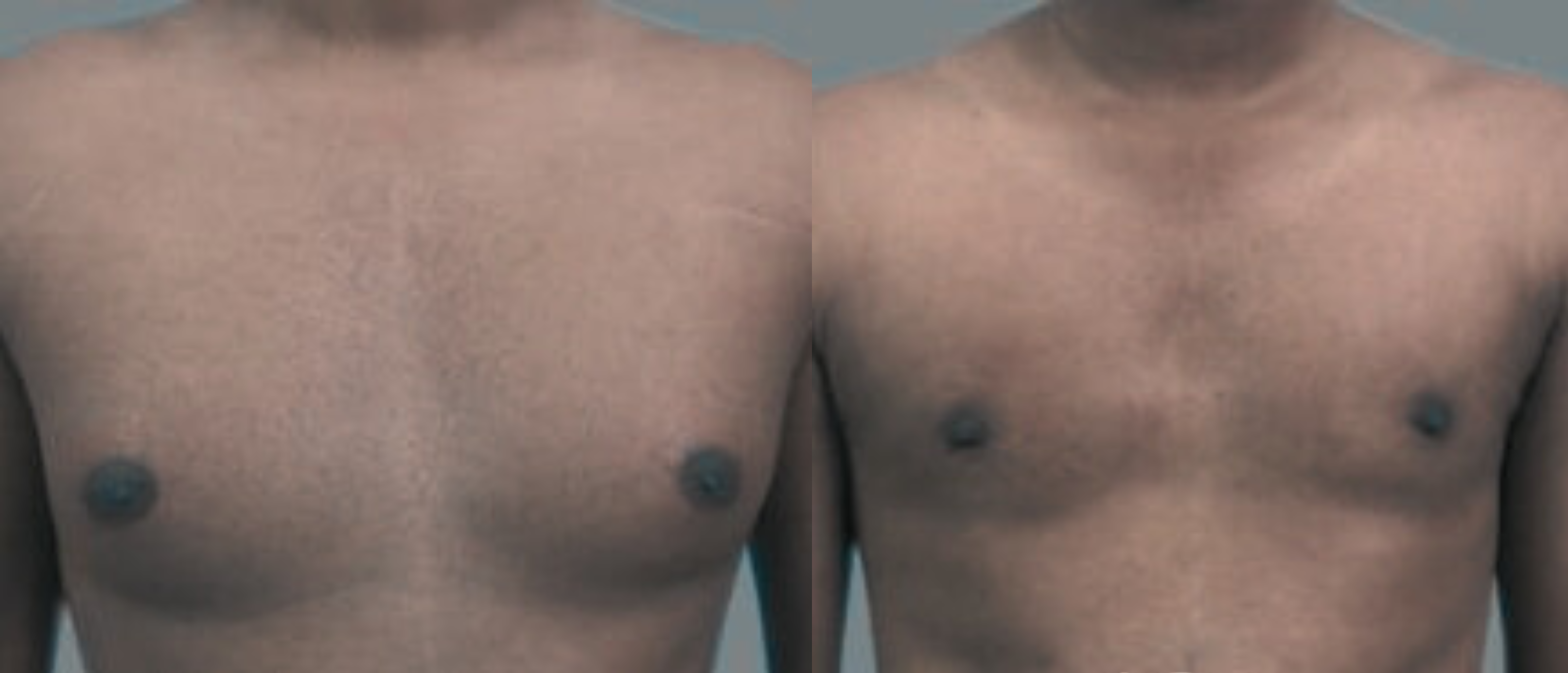 Gynecomastia right image