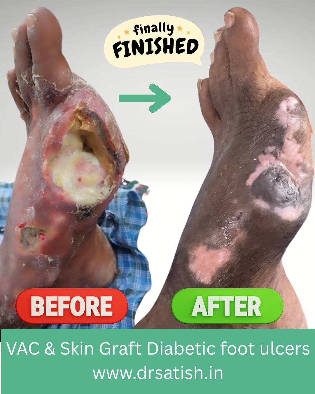 VAC + skin graft + sutures